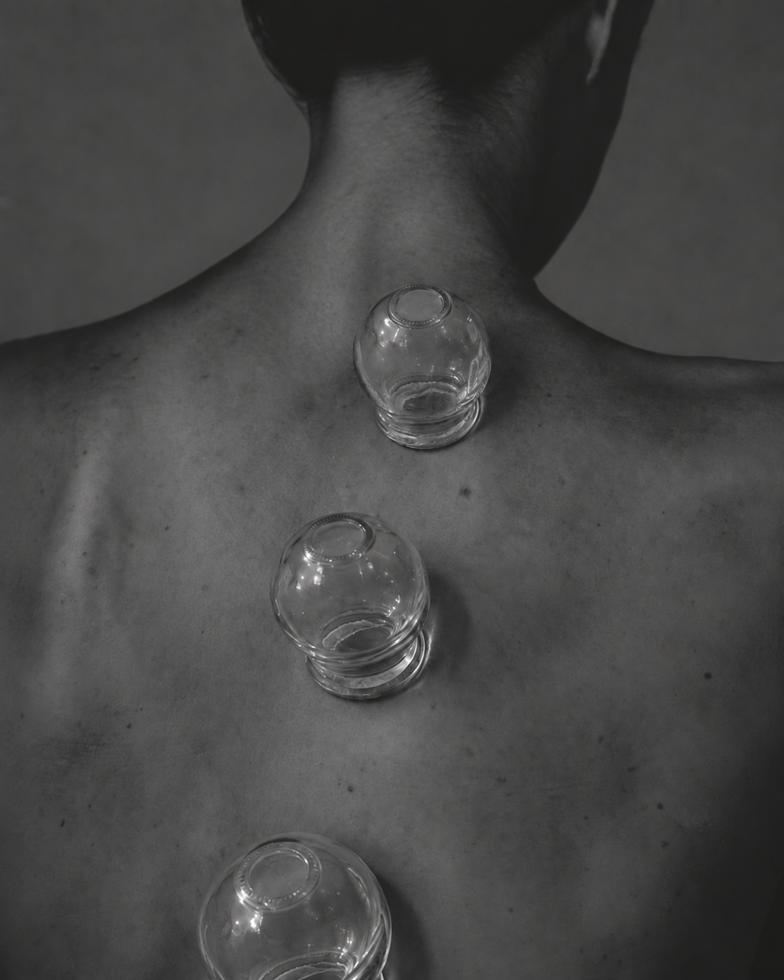 Cupping Therapy at Senuri